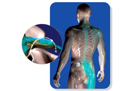 Dorsal Ganglion Stimulation