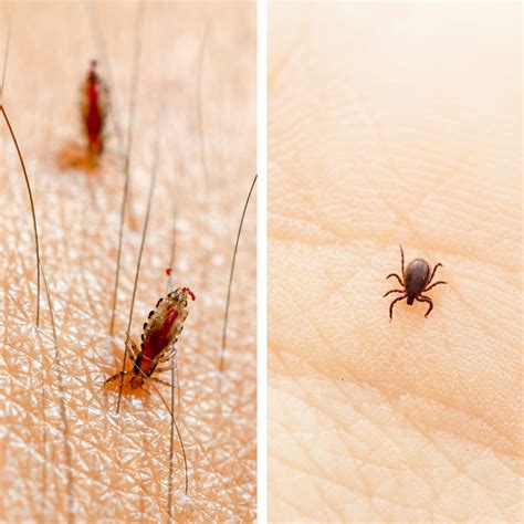 Lice vs. Ticks: Differences You Need to Know - Pest Control