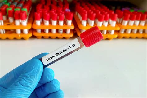 Serum Globulin Test: Types, Purpose, Normal Range & Results