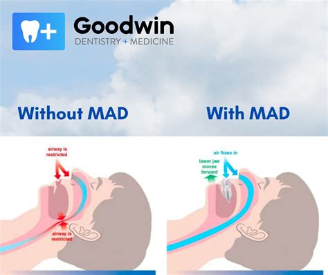 Journey to Dreamland: How Mandibular Advancement Devices Can Help Your Sleep Apnea - Goodwin ...