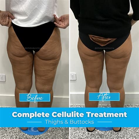Complete Cellulite Treatment | Elite Body Contouring