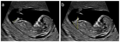 Pro Tips On Determining Sex During An Ultrasound