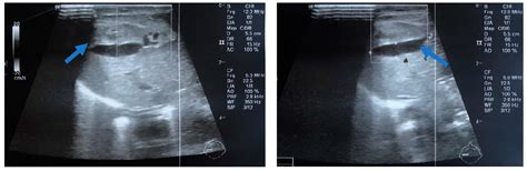 Subcapsular Liver Hematoma—A Life-Threatening Condition in Preterm ...