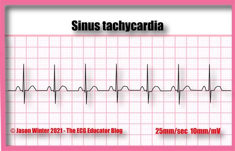 ECG Educator Blog : Sinus Tachycardia