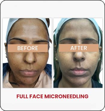 Before & After Skin Treatment Results-DermaClinix
