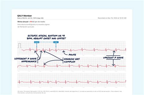 Ectopic Atrial Rhythm Vs. Premature Atrial Contraction (Couplet) on Your Watch ECG | Qaly