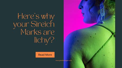How To Get Rid Of Itchy Stretch Marks?