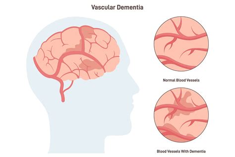 Vascular Dementia: Symptoms, Types, Diagnosis, and Treatment