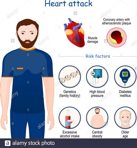 Heart attack. signs, symptoms, and Risk factors. infographic. Cross section of Coronary artery ...