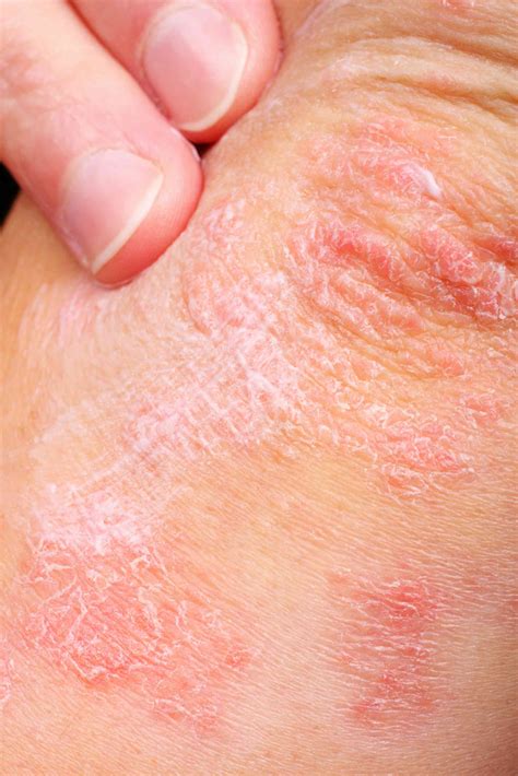 Explainer: what is eczema and what can you do about it?