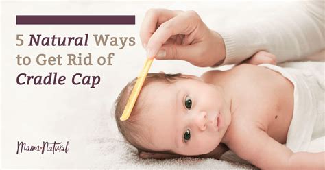 Simple Info About How To Get Rid Of Cradle Cap In Infants - Securityquarter28
