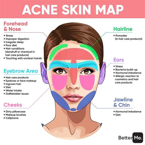 Pro.Skin Laser & Aesthetics on Instagram: “THIS IS WHAT ACNE SAYS ABOUT YOUR HEALTH👆🏻👁 Where do ...