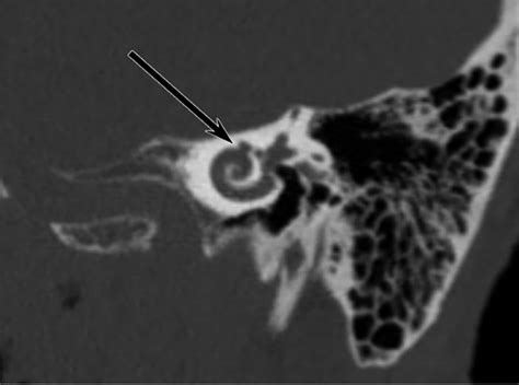Semicircular Canal And Nerve Semicircular Canals E Anatomy IMAIOS