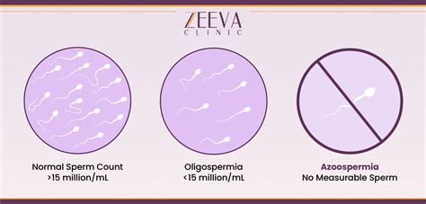 Azoospermia - Meaning, Types, Diagnosis & Treatment