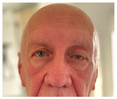 New Onset Generalized Myasthenia Gravis Evolving Following SARS-CoV-2 ...