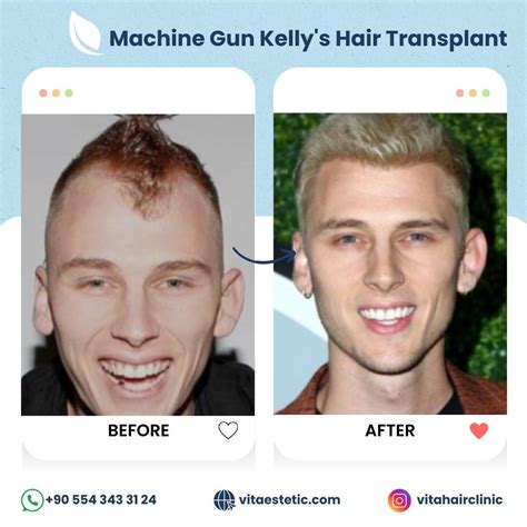 Machine Gun Kelly Hair Transplant: The Story Behind His Hair Restoration