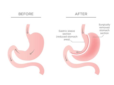 Sleeve Gastrectomy Side Effects