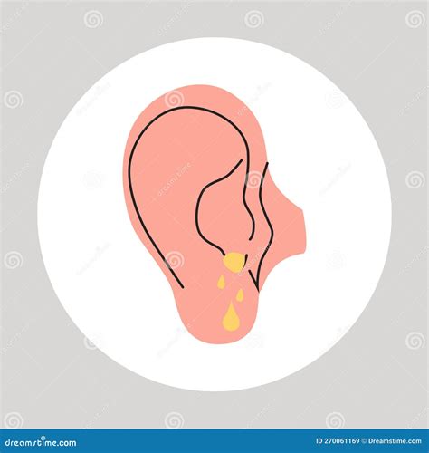 Fluid Draining from the Ear. Otitis, Tinnitus Symptom. Bacteria in the Middle Ear Stock ...