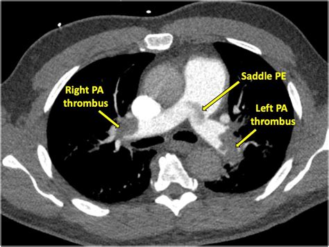 Saddle Pulmonary Embolism Pulmonary Artery Sarcoma Masquerading As