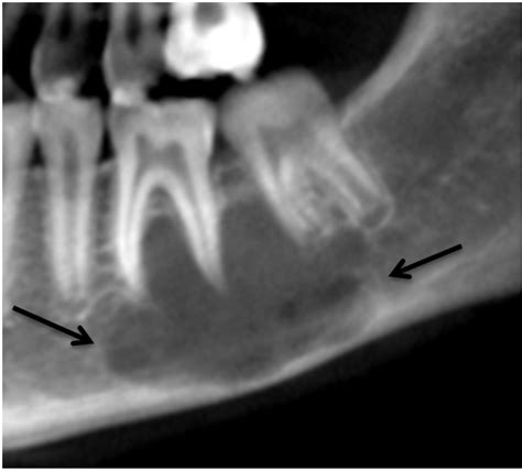 Traumatic Bone Cyst