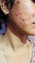 PLIX - THE PLANT FIX Jamun Face Wash and Active Acne Serum Combo(100ML ...