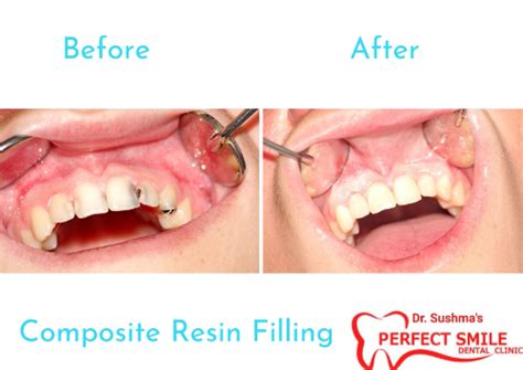Before and After – Perfect Smile Dental Clinic
