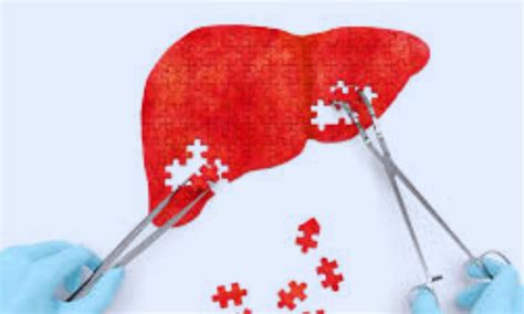 MRI Outperforms Ultrasound in Detecting Liver Cancer During Cirrhosis ...