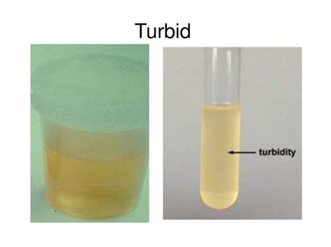 Turbidity In Urine Means