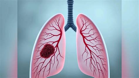 Lung cancer alert: Doctors say it’s not just for smokers — watch for ...