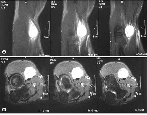 Figure 3 from A rare type of peripheral nerve sheath tumor: radial nerve schwannoma. | Semantic ...