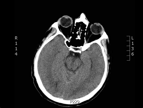 Normal Head CT - JETem