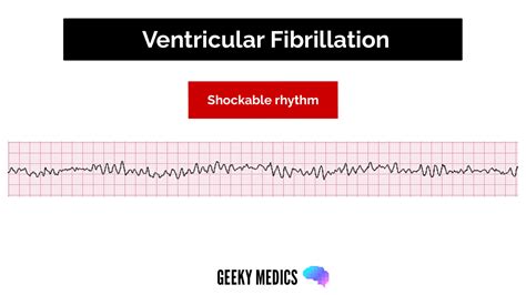 Shockable vs. Non-shockable Rhythms in Cardiac Arrest | Geeky Medics