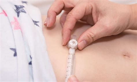 A Complete Guide to Pediatric Feeding Tubes - Rare Parenting