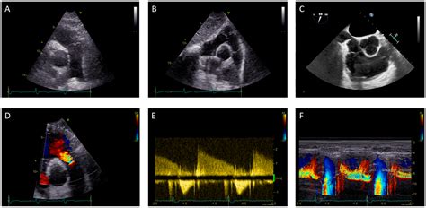 Multimodality Imaging of the Neglected Valve: Role of Echocardiography ...