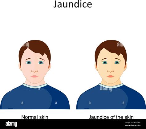 Jaundice. Signs and symptoms of disease. comparison and differences ...