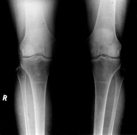 X Ray Knee Normal Normal knee x-rays (9-year-old) | Image | Radiopaedia.org