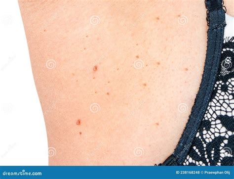 Close Up Skin Tags from Under Armpit in Asian Woman Middle Age. Caused ...