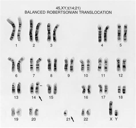 Robertsonian Translocation Karyotype