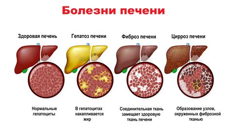Что такое холестаз на коже