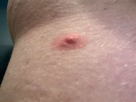 Image result for Explosive Back Cysts