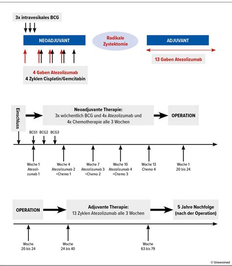Kombination von lokaler und systemischer neoadjuvanter Immuntherapie b ...