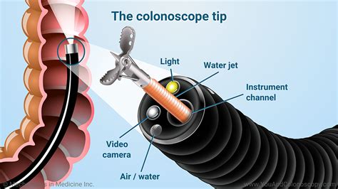Image result for Loop Colonoscopy