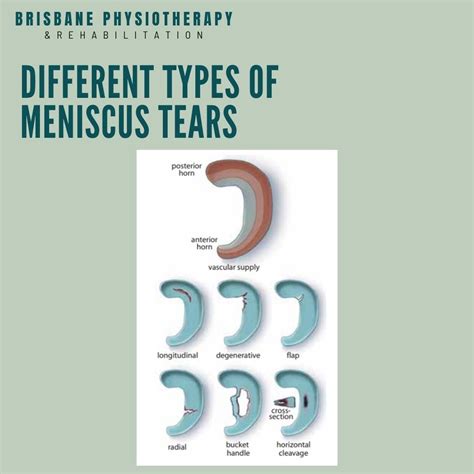 Meniscus Tear/Injury - What is it? Symptoms, Treatment, Rehab & Physio - Brisbane Physiotherapy ...