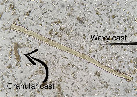 Hyaline Cast In Urine Casts | EClinpath
