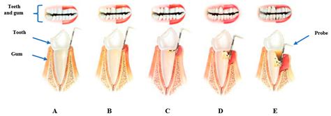 Antibiotics For Gingivitis In Humans at Janie Clark blog