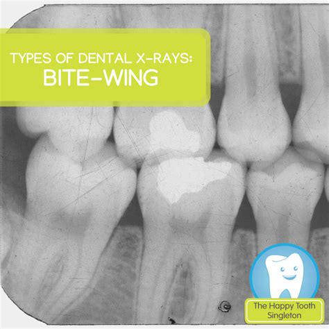 Types of dental x-rays: Bite-wing | The Happy Tooth Singleton - can babies have x rays