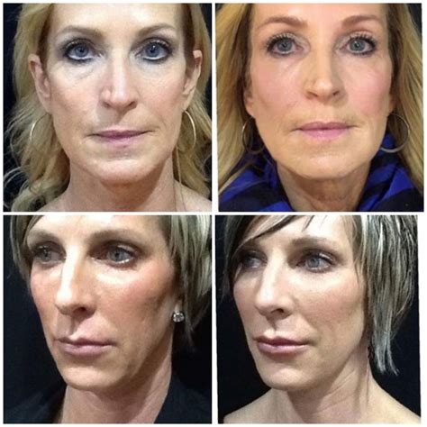 Sculptra Duluth MN | Smile Line Fillers Northern Minnesota | Twin Ports Dermatology & Med Spa