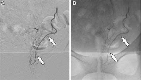 Rectal Artery Embolization for Hemorrhoidal Disease: Anatomy, Evaluation, and Treatment ...