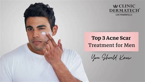 Pimples On Face Removal Tips For Men