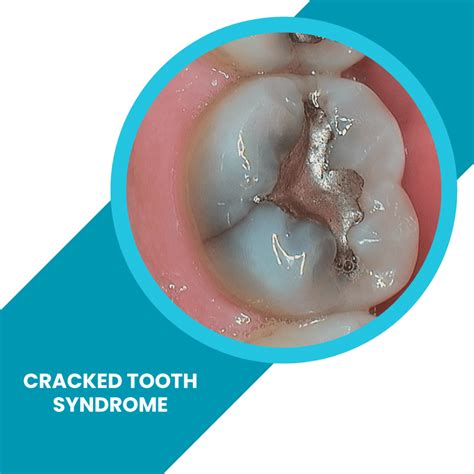 Cracked Tooth Syndrome - What Are the Symptoms?